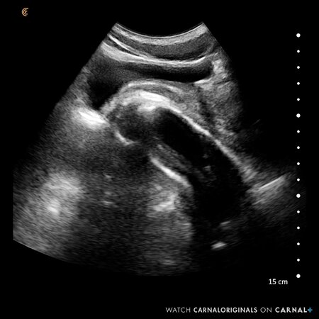 Dr. Legrand Wolf ultrasounds professor Adam Snow throat and prostate